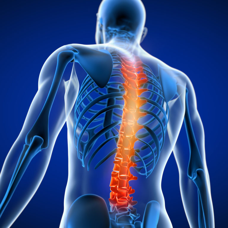 ANTERIOR LUMBAR INTERBODY FUSION - Texas Spine Care Center