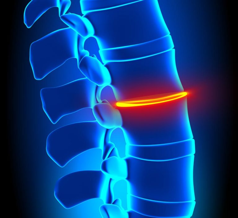 MICRODISCECTOMY - Texas Spine Care Center