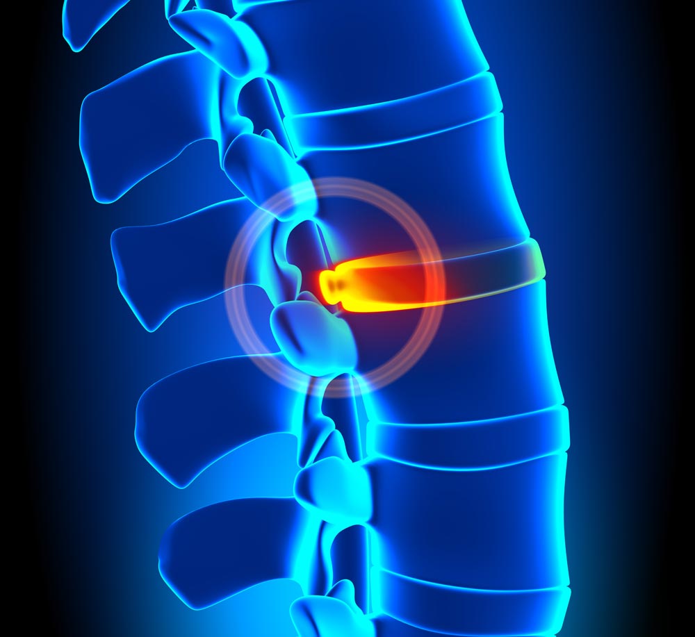 BULGING DISC Texas Spine Care Center