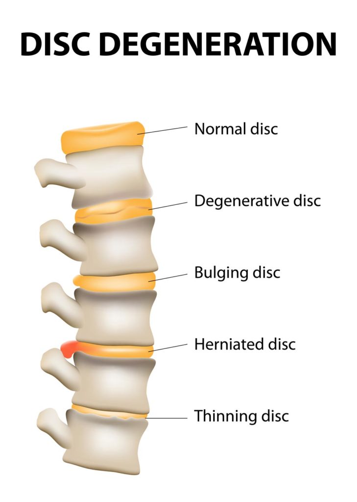 DEGENERATIVE DISC DISEASE - Texas Spine Care Center